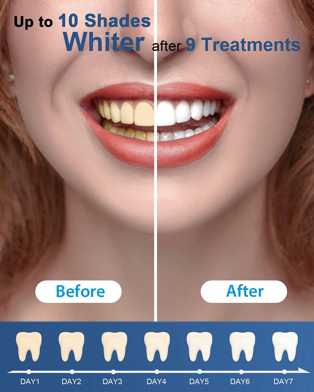 MySmile Teeth Whitening Gel Pen Refill Pack, 3 Pens - Image 5
